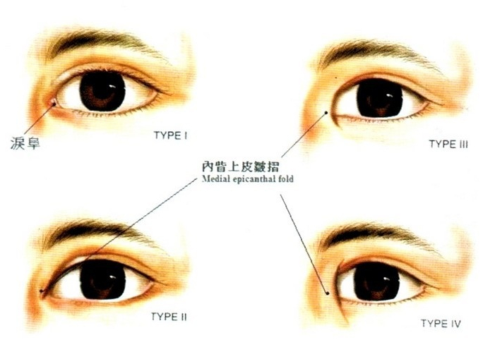 眼部美容治療：眼頭造形 - 仁恩醫學